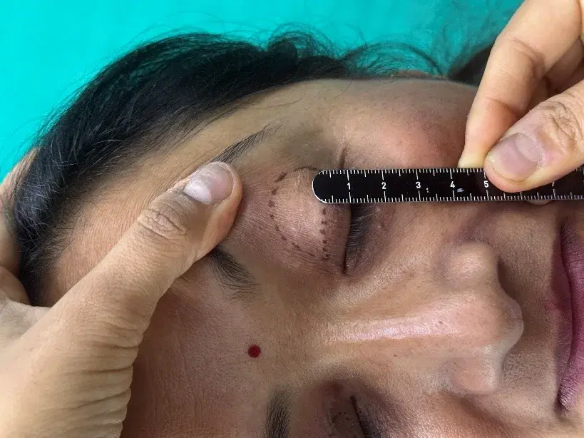 Measuring and marking an upper eyelid before surgery