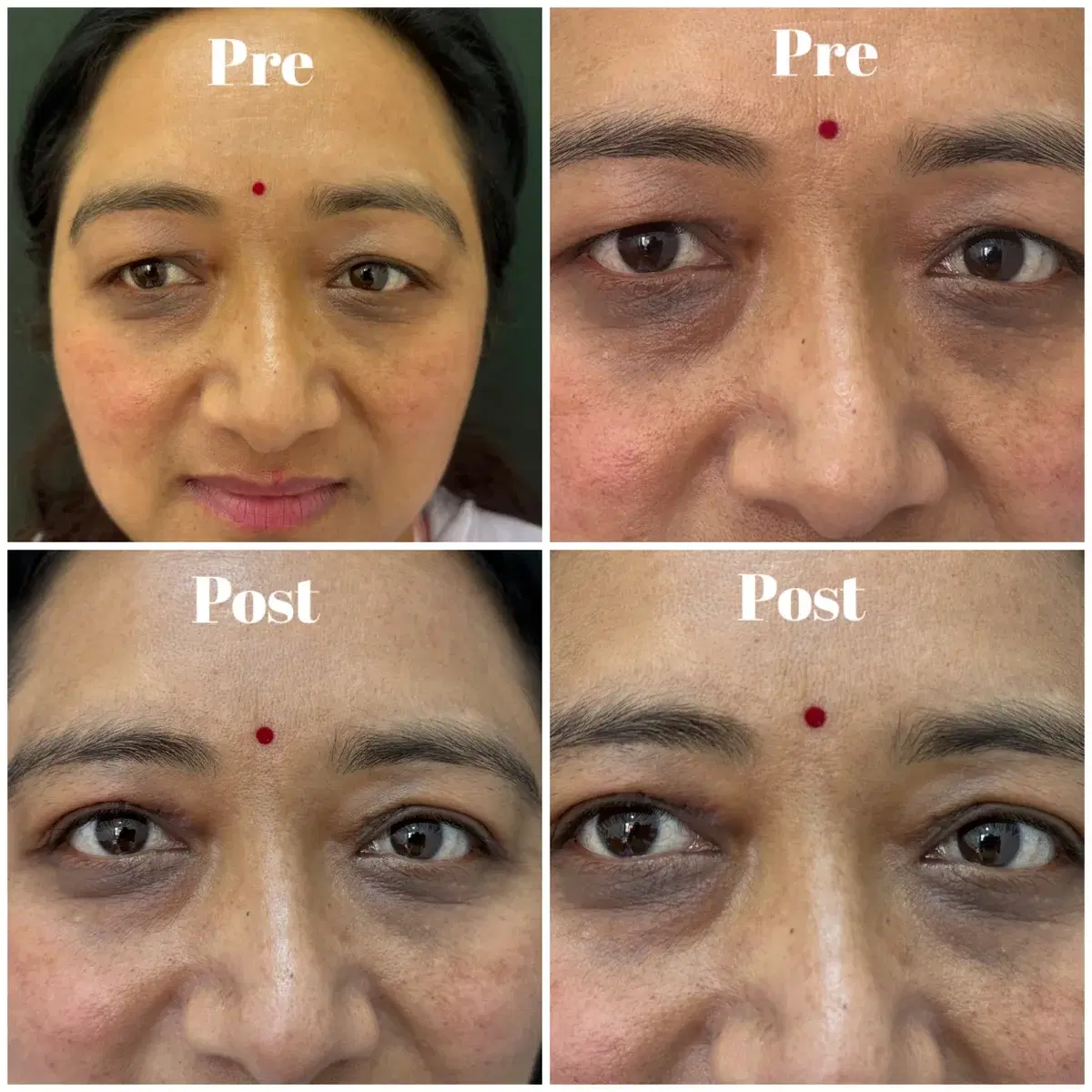 Clinic case photographs comparing eyelids before and after surgery