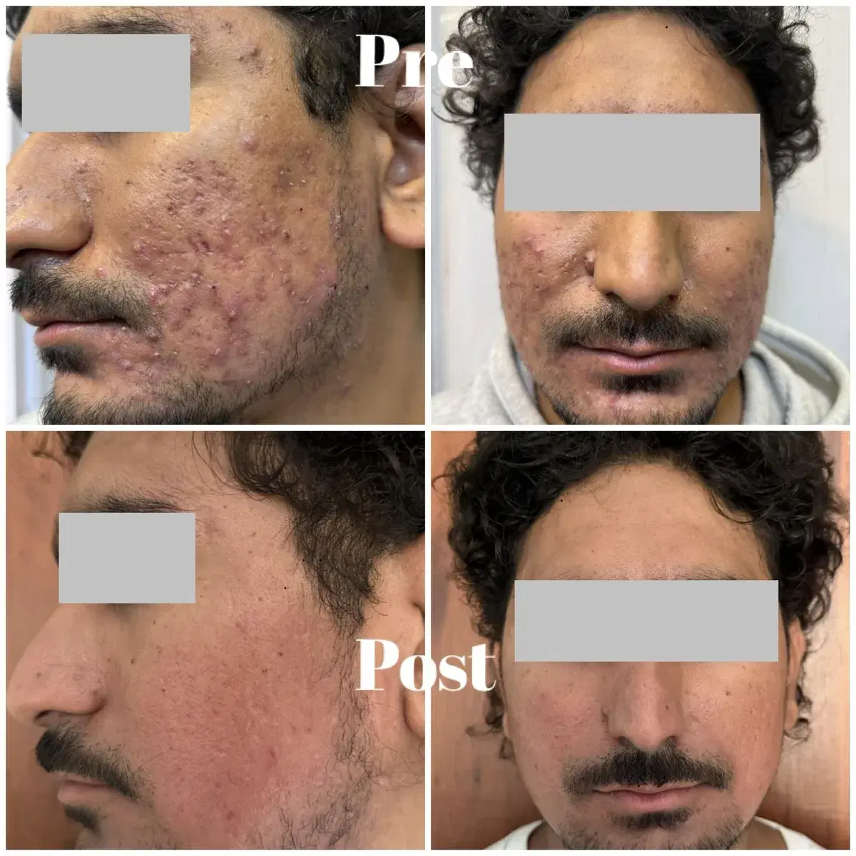 Acne treatment: before and after treatment