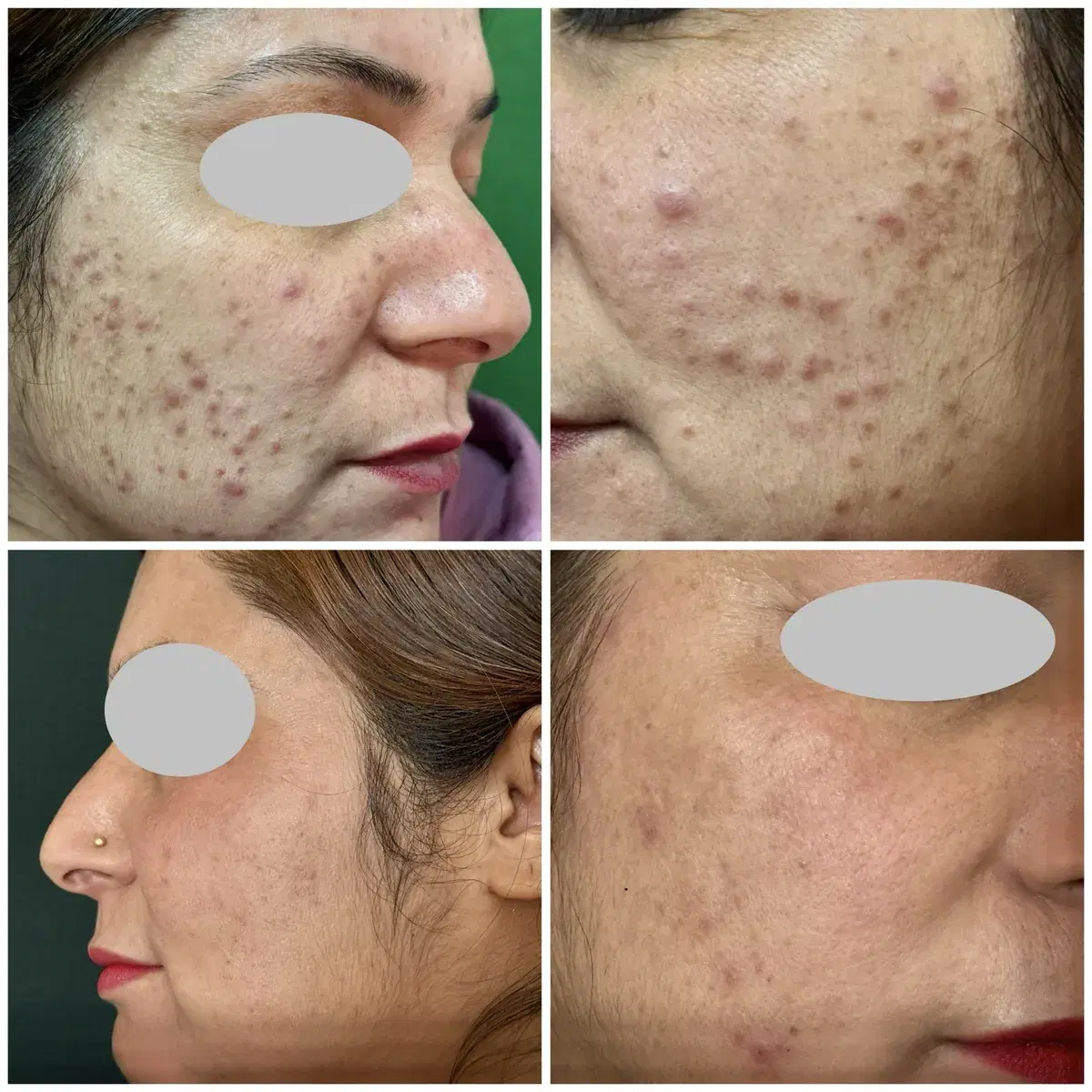 Acne treatment: before and after treatment