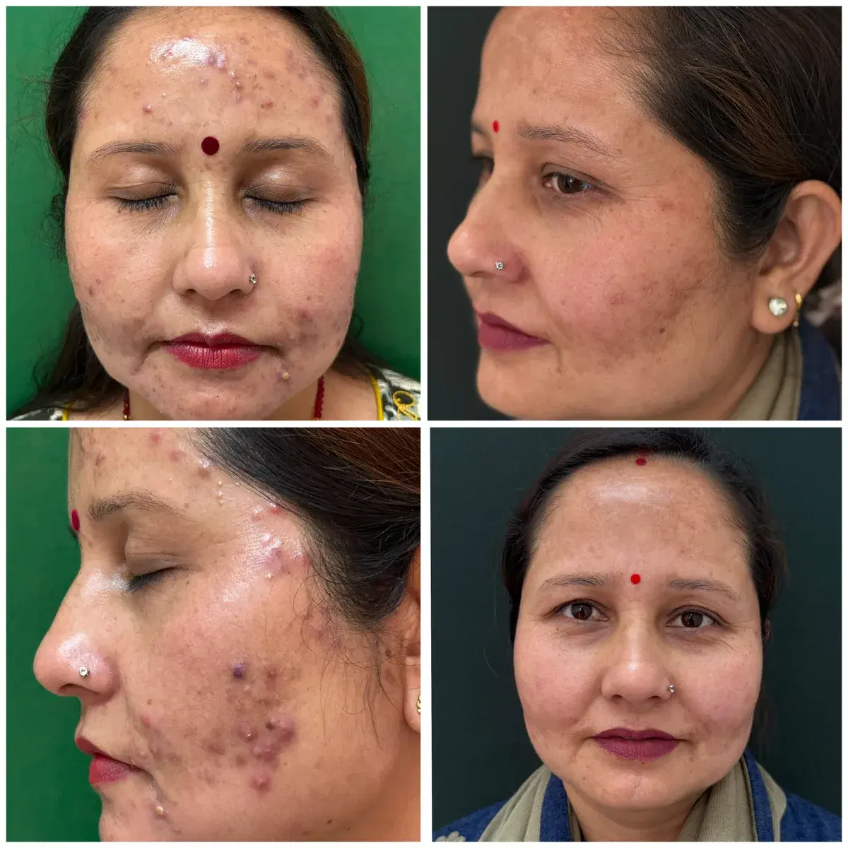 Acne treatment: before and after treatment