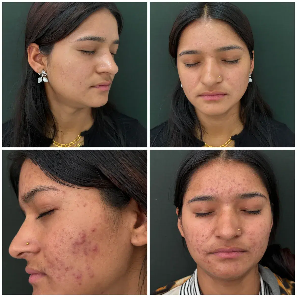 Acne treatment: before and after treatment