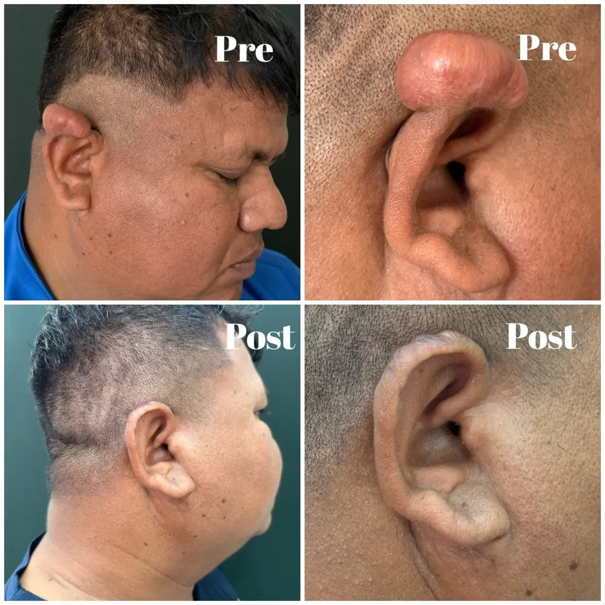 Keloid removal: before and after treatment