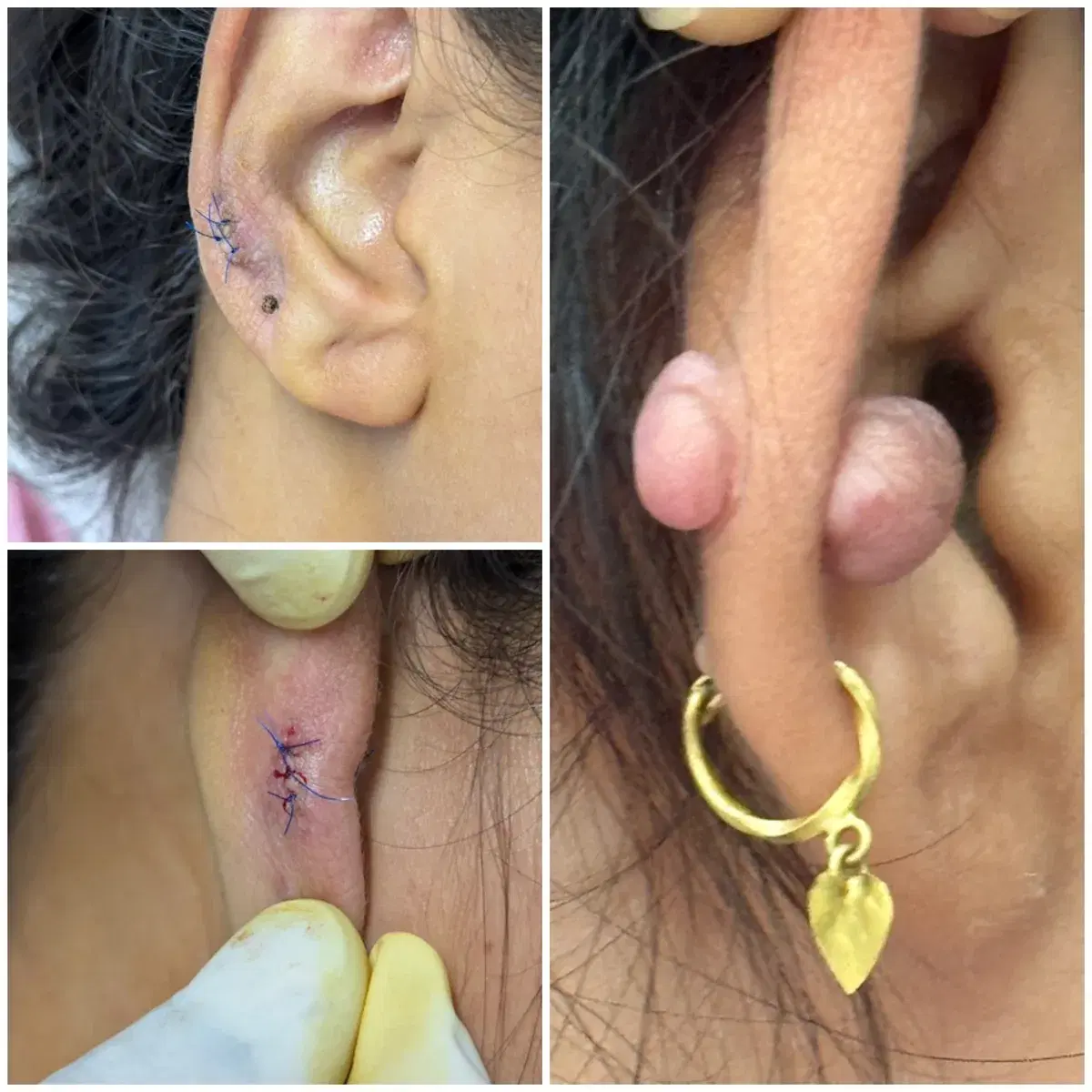 Keloid removal: before and after treatment