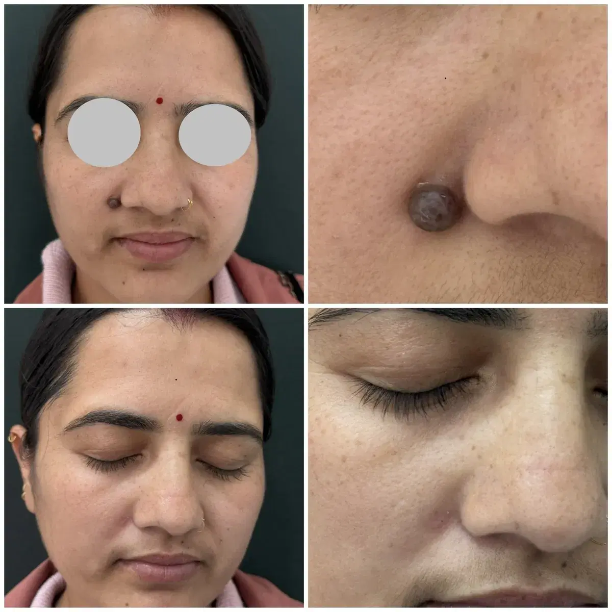 Mole removal: before and after treatment
