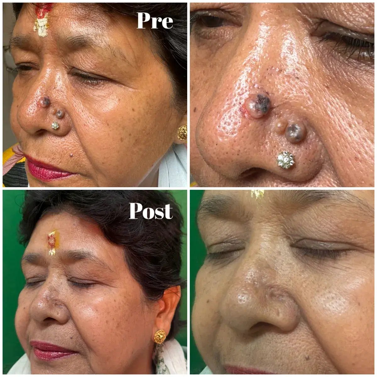 Mole removal: before and after treatment