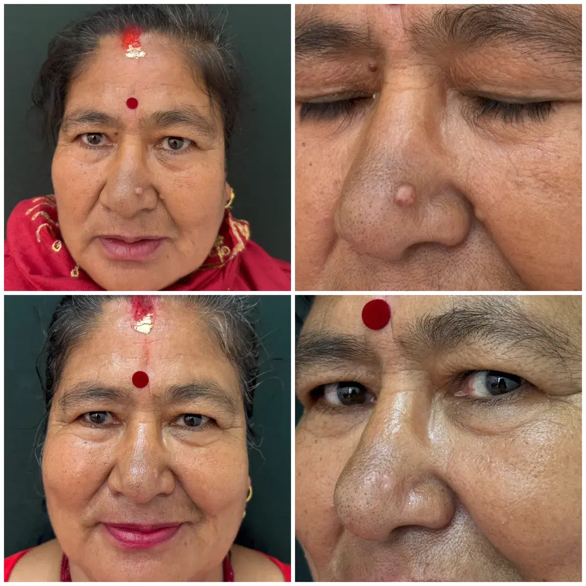 Mole removal: before and after treatment