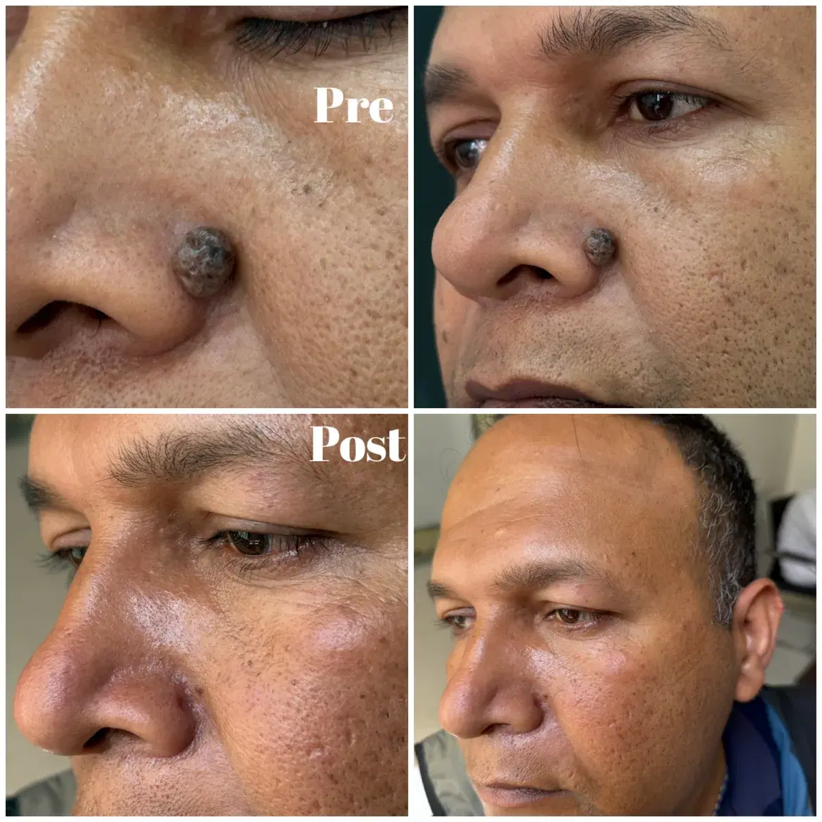 Mole removal: before and after treatment
