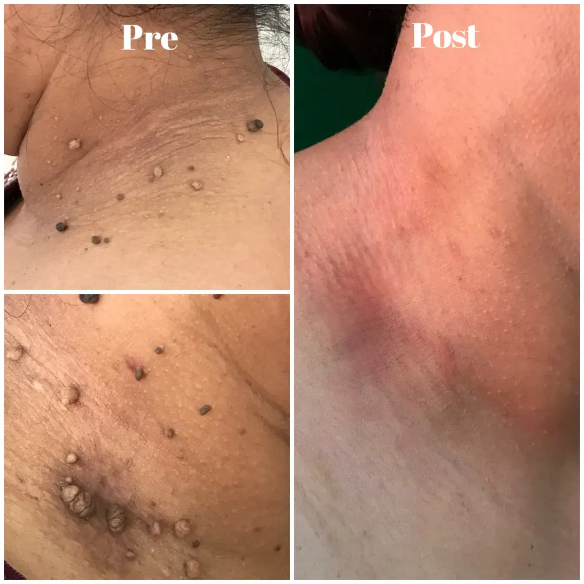 Skin tag removal: before and after treatment