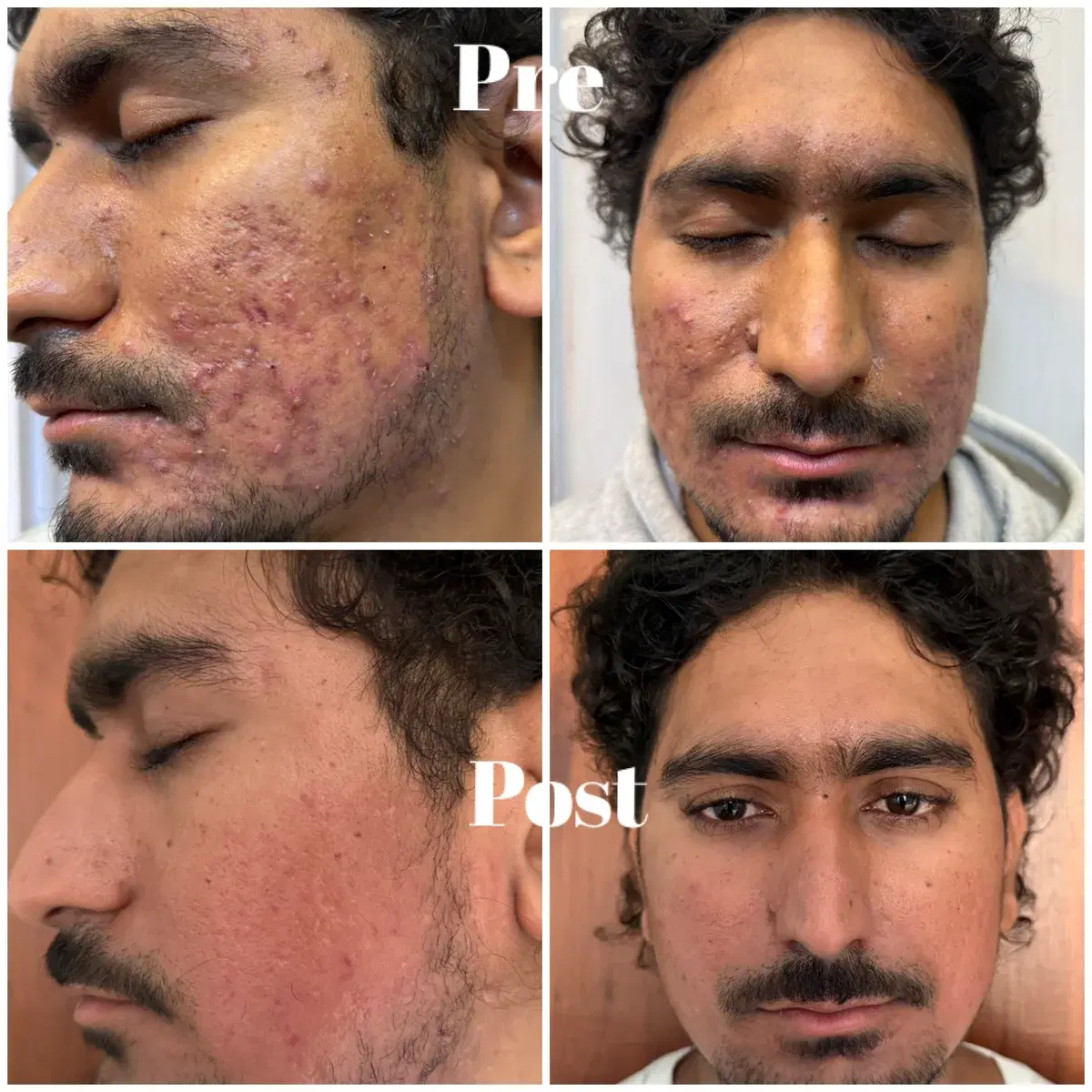 Clinic case photographs of facial acne before and after treatment