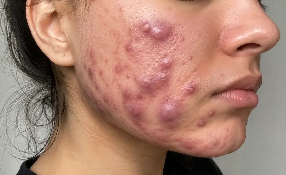 Inflamed acne bumps and scarring on a cheek