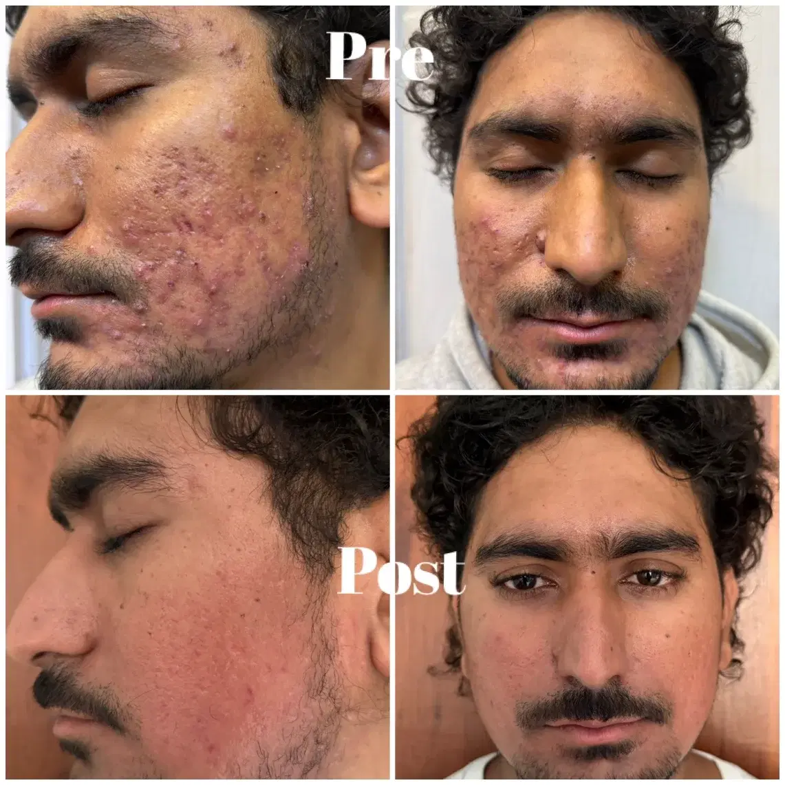 Clinic case photographs of facial acne before and after treatment