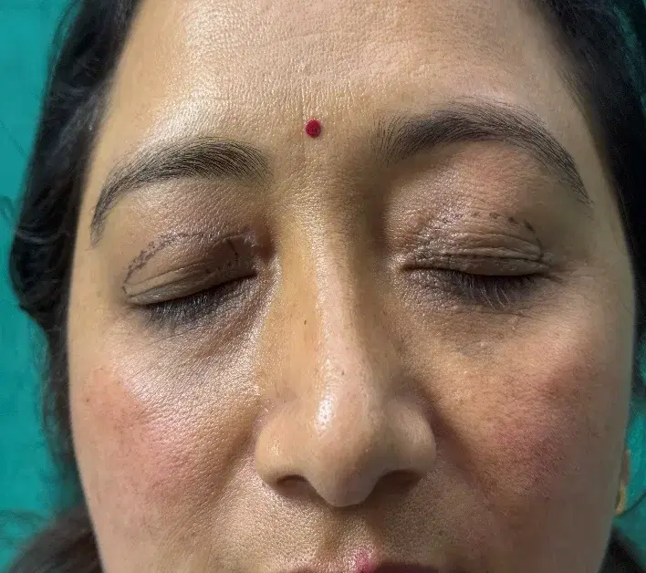 Closed eyelids with stitches after an eyelid procedure