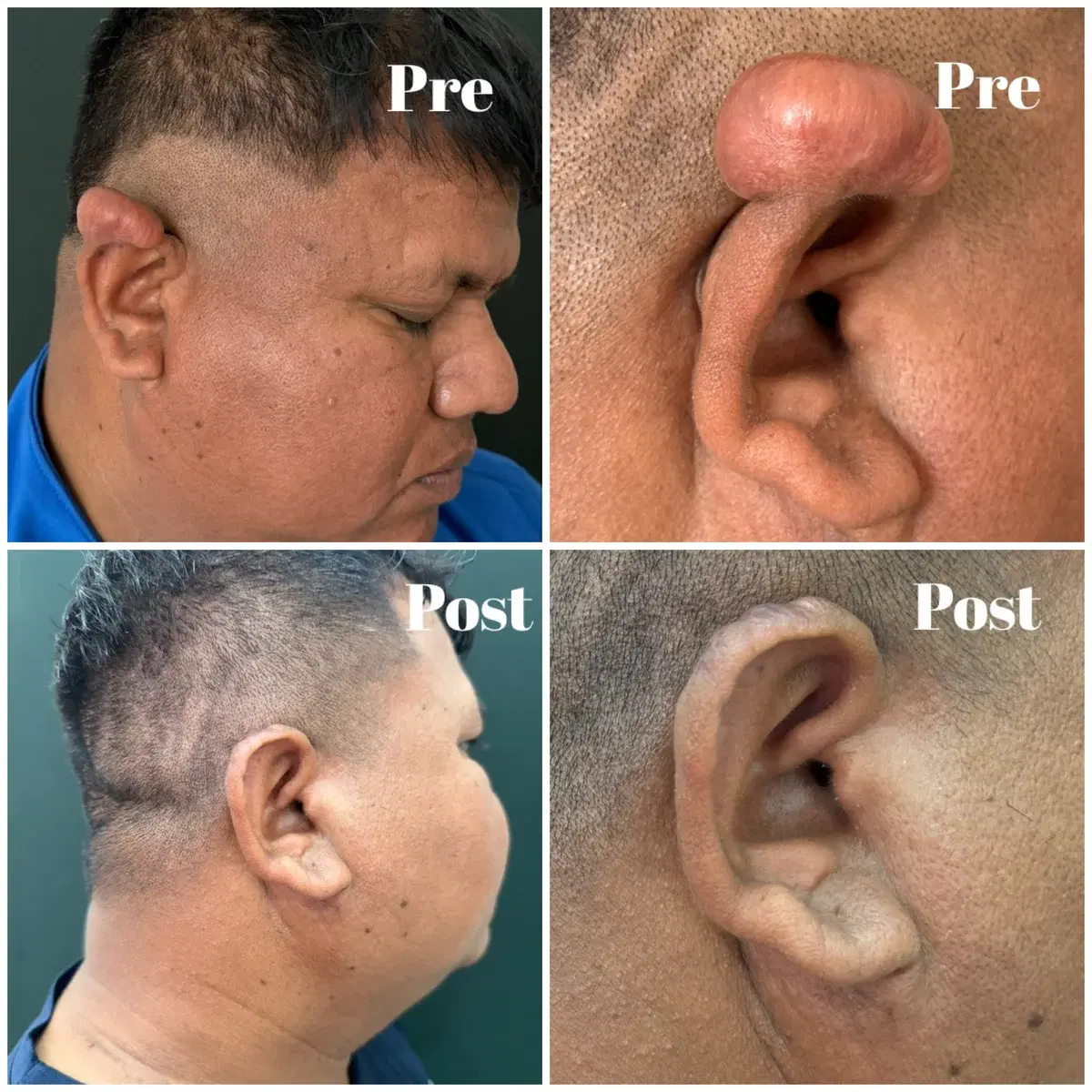 Clinic case photographs of a large ear keloid before and after treatment