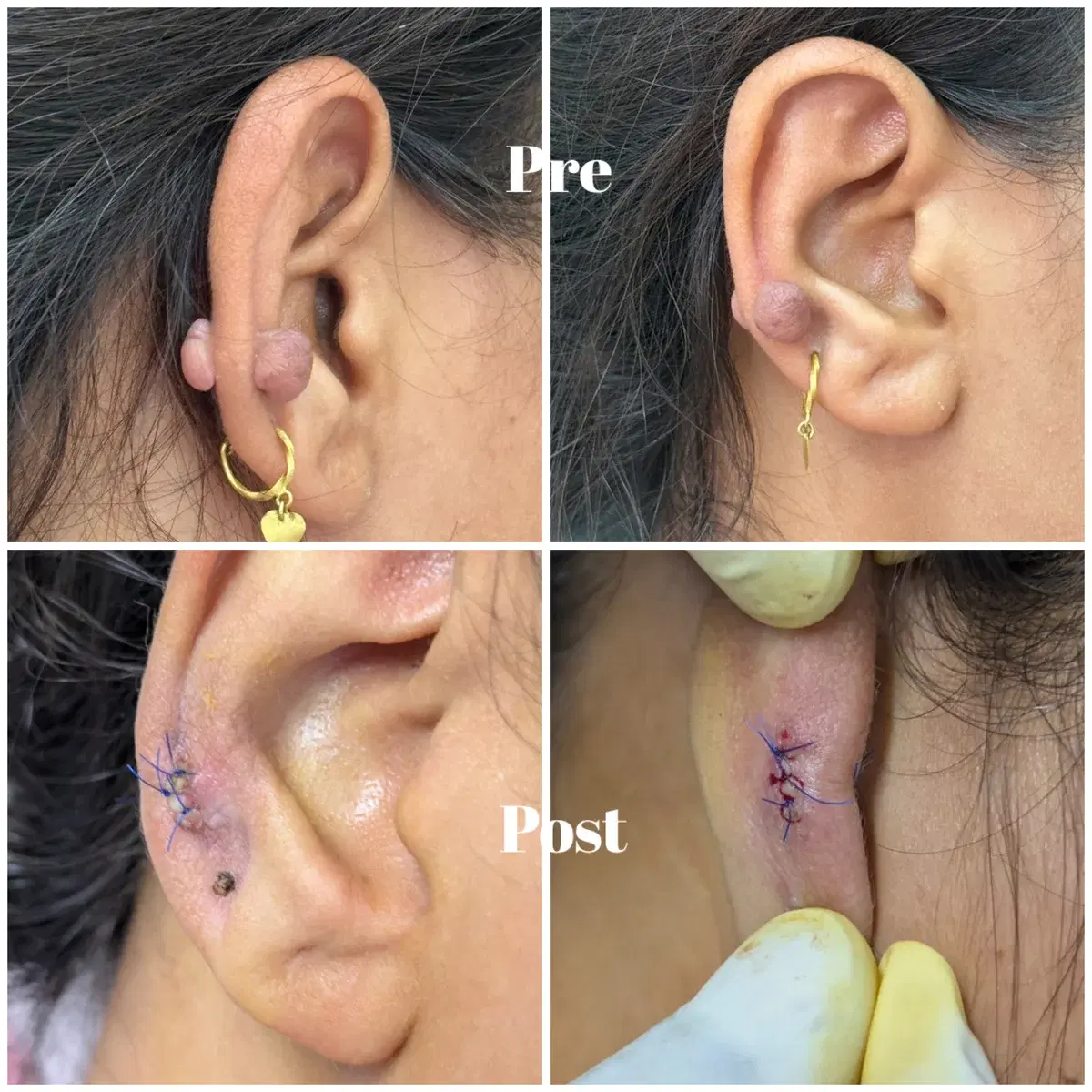 Clinic case photographs of earlobe keloids before and after removal