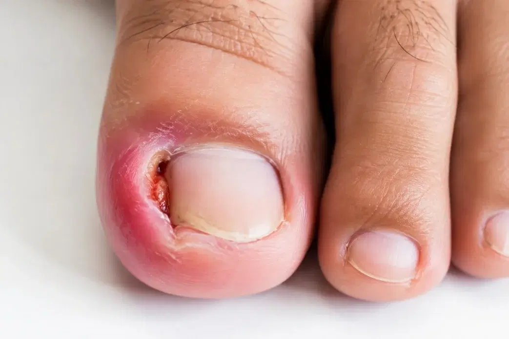 Redness and swelling beside an ingrown big toenail