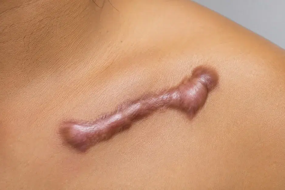 A raised, elongated scar on a shoulder