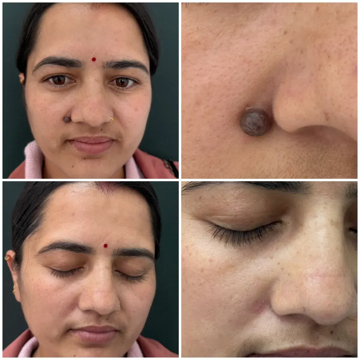 Clinic case photographs of a mole beside the nose before and after removal