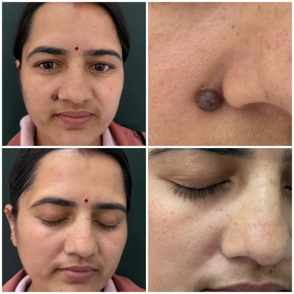 Clinic case photographs of a mole beside the nose before and after removal