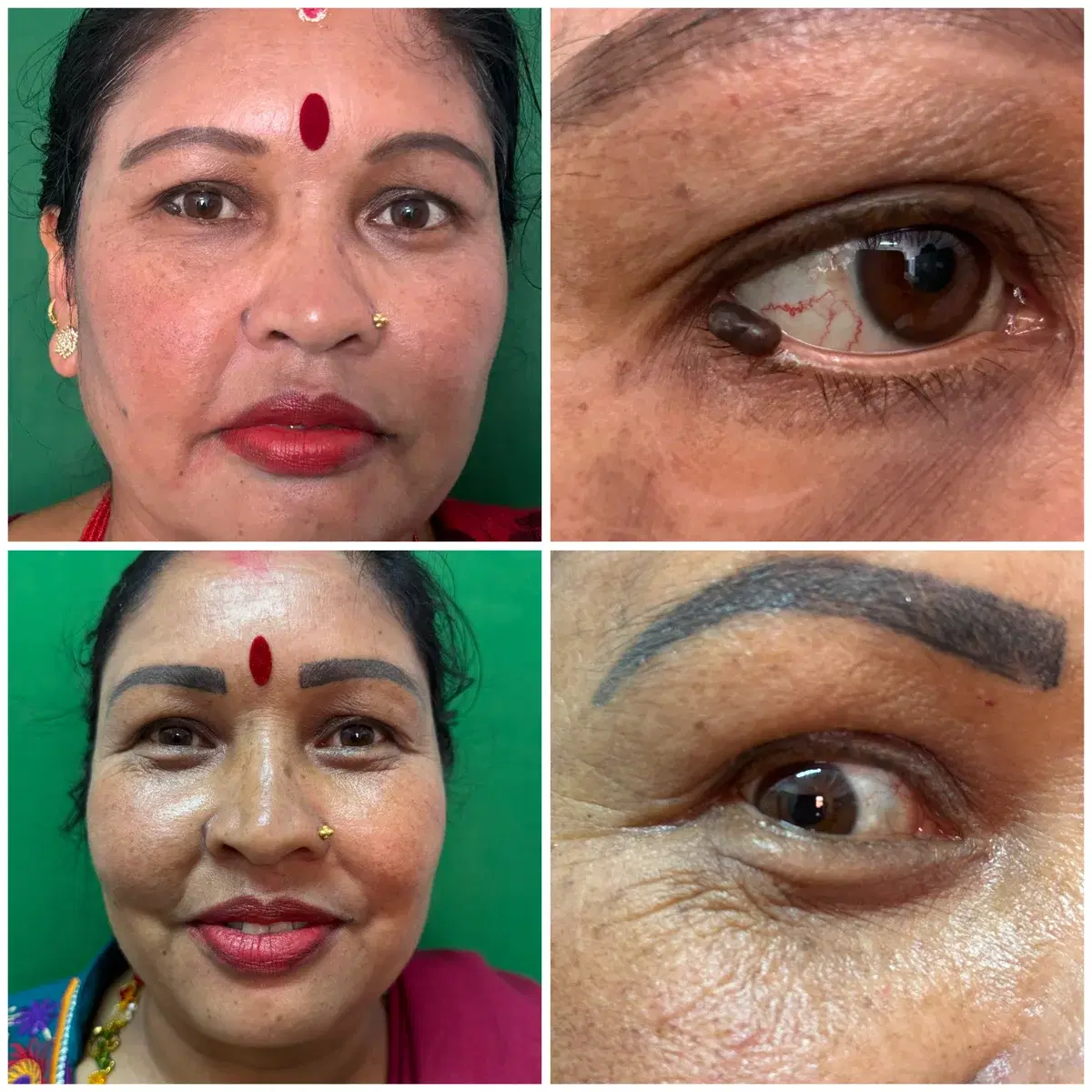 Clinic case photographs of an eyelid mole before and after treatment