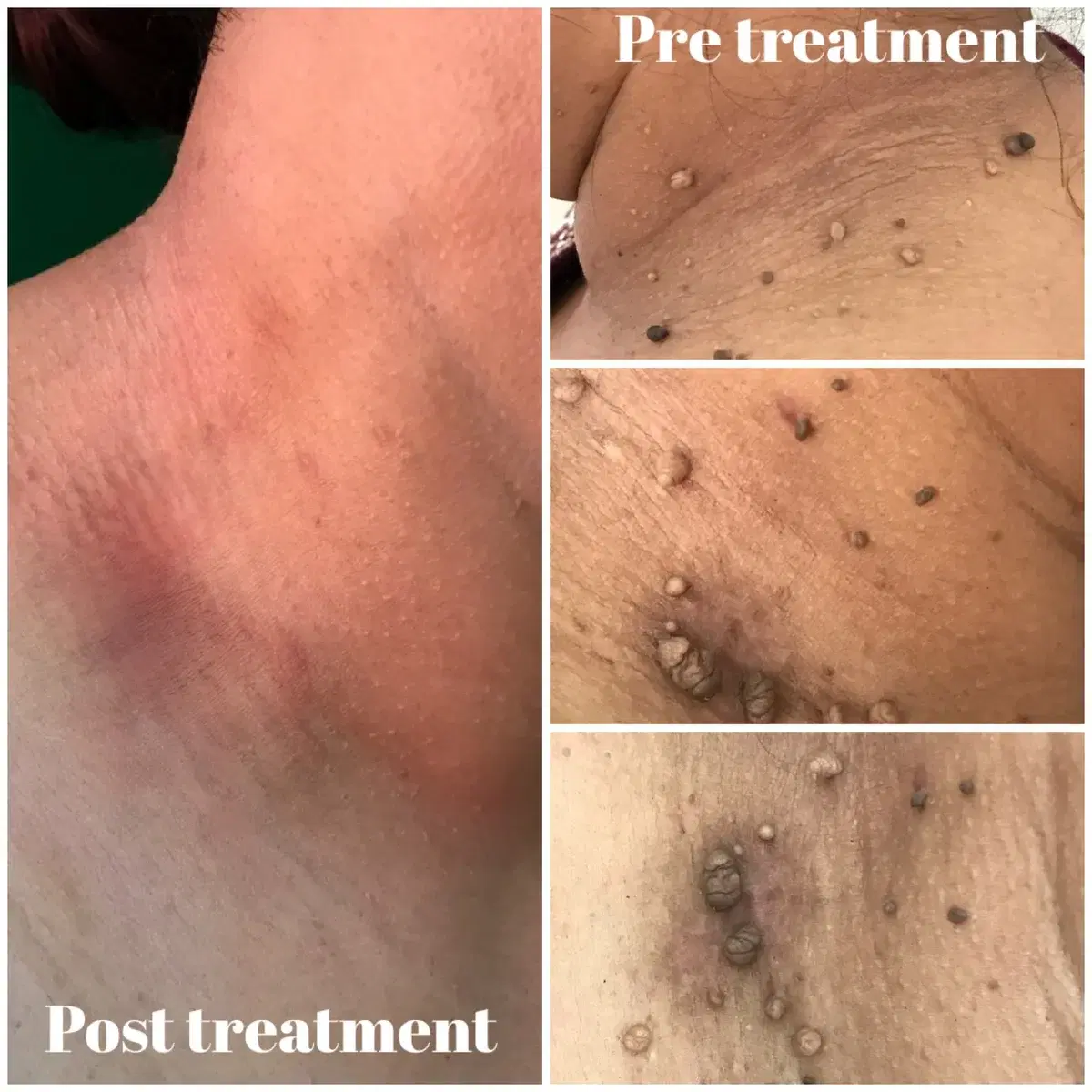 Clinic photographs comparing neck skin tags before and after treatment