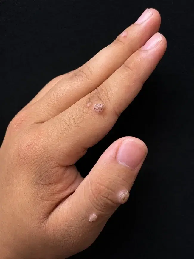 Several raised warts on the fingers and back of a hand